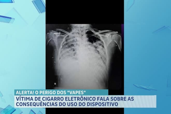 Vapes: veja os prejuízos de cigarros eletrônicos para a saúde
