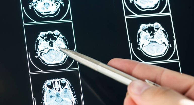 Novo remédio pode mudar o destino de pacientes com Alzheimer