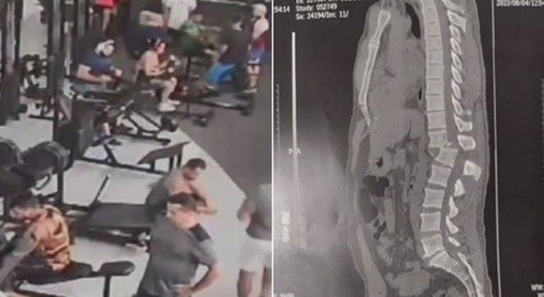 Homem atingido por aparelho em academia consegue se sentar após cirurgia