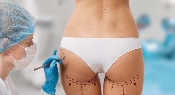 Entenda a cirurgia do 'bumbum brasileiro', que vem causando polêmica na Flórida