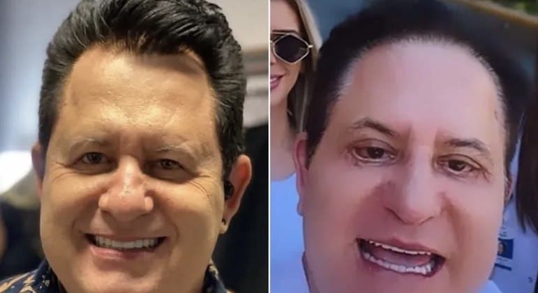 Saiba detalhes do pânico de Marrone com cirurgia plástica que deu problema